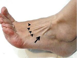 foot tendons - collagen for tendons